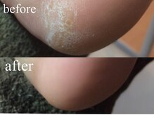 パラグラフ 橋本店(paragraph)/かかと角質ケア