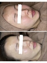 エマ(ema)/ララピール