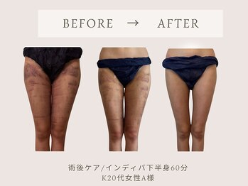 フェリチタトウキョウ(Felicita Tokyo)/術後ケア_インディバ40分