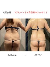 エクラ(ECLAT)/コアヒート痩身