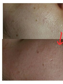 ベビースキン(baby skin)/肌改善