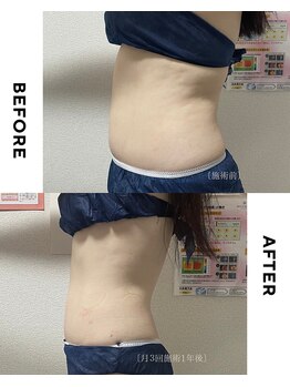 ホソナル(HOSONAL)/コツコツダイエット