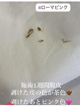 リツイート(ReTweet)/ローマピンク　施術一週間脱皮