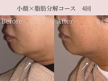 ミア(miiia)/小顔×脂肪分解コース 4回