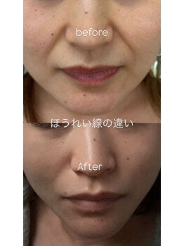 ハイム(HAYIM)/一回で実感!ほうれい線ケア