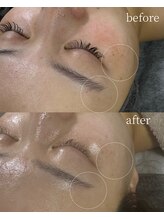 サロンナナジュウニ(Salon72)/シミ/くすみ