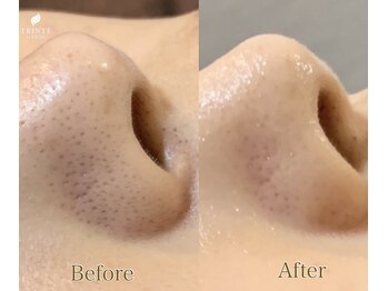 トリンテ バイ フェース(TRINTE by FAITH)/【フェイシャルWAX】1回