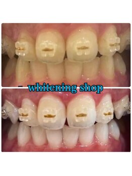 ホワイトニングショップ 西宮北口店/【お客様のビフォーアフター】