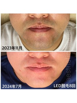 エステ シンセリティー(aesthetic sincerity)/メンズヒゲ脱毛!LED脱毛