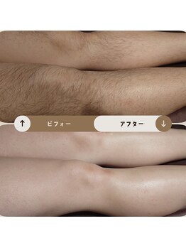 ジュゴン(Dugong)/足の全体脱毛（Before＆After）