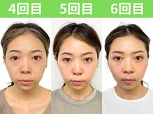 ナチュラルビューティーフェイス 横浜(NBF)/小顔矯正/ビフォーアフター