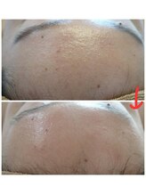 ベビースキン(baby skin)/肌改善