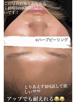 リツイート(ReTweet)/ハーブピーリング・艶・くすみ