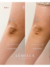 エルビービュティーサロン(LB BEAUTY SALON)/【ルメラ乳輪】実績数関西1★