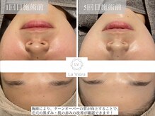 ラヴィオーラ 福島野田店(La Viora)/ダイヤモンドハーブピーリング