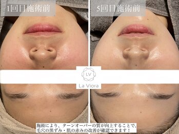 ラヴィオーラ 福島野田店(La Viora)/ダイヤモンドハーブピーリング