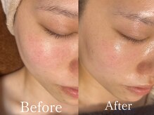 サロン ド エン(Salon de. en)/肌荒れケア◇ハーブピーリング