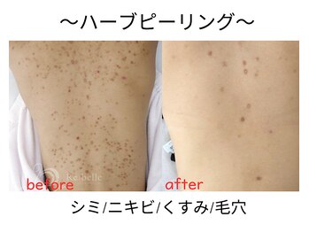 エール シガ(AILE SHIGA)/【ハーブピーリング】