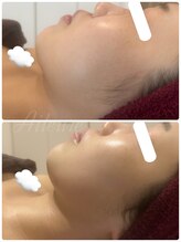 エルール トータルビューティ(Aileure total beauty)/ダウンタイムケアフェイスライン