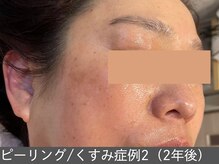 オアシスラグーン(OASIS LAGOON)/ピーリング（症例2_2年後）60代