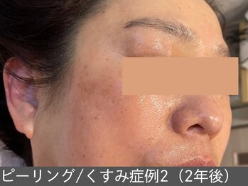 オアシスラグーン(OASIS LAGOON)/ピーリング(症例2_2年後)60代