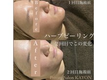 カヨン 新所沢店(KAYON)/韓国発！最高級ハーブピーリング