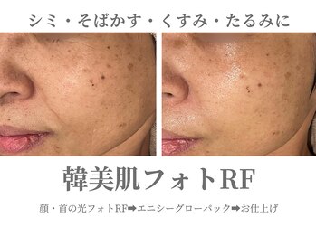 エクラ イオンモール徳島店(ECLAT)/韓美肌フォトRF+CO2パック