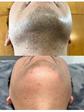 エナ バイ アオヒゲ(ena by AOHIGE)/ヒゲ脱毛