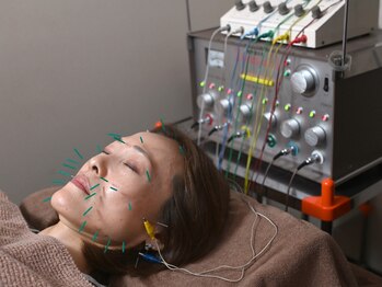 大勝鍼灸整骨院プライマリィの写真/電気美容鍼とは・・・顔のツボに鍼を刺し、そこに電気を流して肌や筋肉を活性化!リフトUPした憧れの小顔へ!