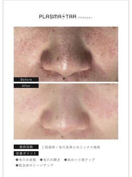 ビューティーサロンエイト(Beauty Salon8)/wax×プラズマ