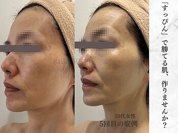 リボーン 柏(REBORN)/柏で人気の美白フォトケア