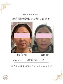 ルブラン(Le Blanc)/before after のお写真