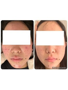 パリライム(parislime)の写真/トラブル肌ビフォーアフター全国コンテスト準グランプリ★酒さ/赤ら顔/ニキビご相談ください！