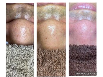 キコ リラクゼーションサロン(KICO by PLUS)/男性毛穴エクストラクション