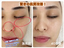 フェイシャルエステ エムズルーム(M's room)/手軽に出来るハーブ★即効美肌♪