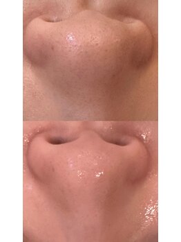 ステージ(Stage)/毛穴洗浄・ハイドラフェイシャル