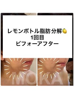 モカ(MOKA)/レモンボトルフェイシャル