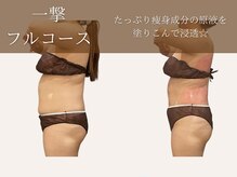 ベベティー(BEBETIE)/一撃コースで短期間ダイエット☆