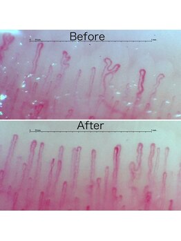 鍼灸ひなた治療院/【水素吸入】Before→After