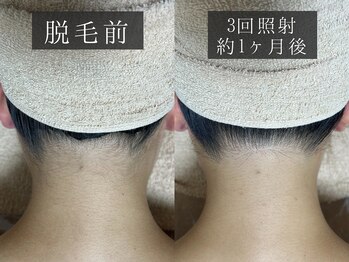 ベルフィーヌ 恵比寿店(BELFINE)/jerryの脱毛が選ばれる理由