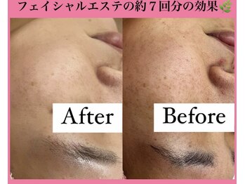 フェミニー(Feminy)/お肌も変わる、シミも改善