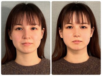 カナエルサロン 旭川(KANAERU SALON)/【小顔ケア】症例☆