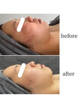 ミュアン(La Mueien)/赤み・ニキビケア・敏感肌