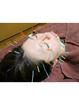 鍼灸施術を受けたい