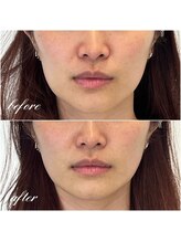 シーズボーテ(C's Beaute)/一度でフェイスラインもスッキリ