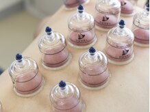 ビーマスター(B-Master)/【慢性肩こり・腰痛】カッピング