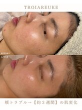 ファシネアオヤマ(FACINE AOYAMA)/TROIAREUKEでノーファンデ肌へ♪