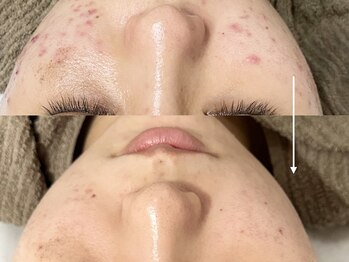 パールフェイスエステ ルペルル(PEARL FACE ESTHE la perle)/ニキビケア