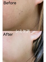 アレイズ(ARAYS)/症例