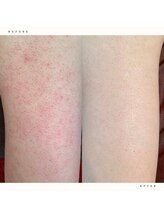 イチロクイチハチ(1618)/二の腕のポツポツ 症例紹介